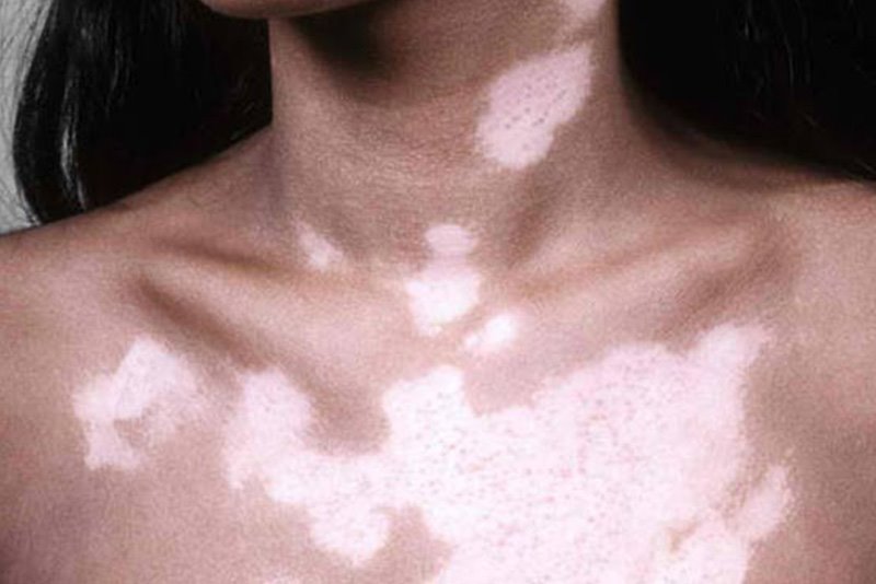 Vitiligo