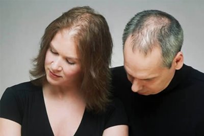 Androgenetic Alopecia