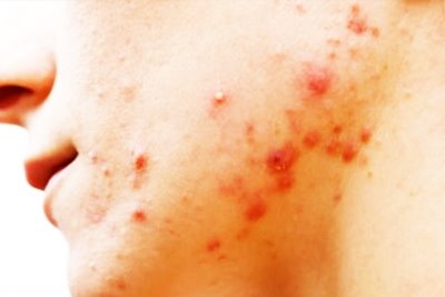 Acne Blackheads