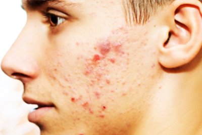 Acne Vulgaris