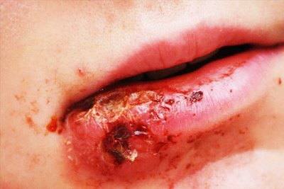 Bacterial Skin Infections