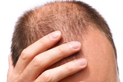 Androgenic Alopecia