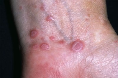 Lichen Planus