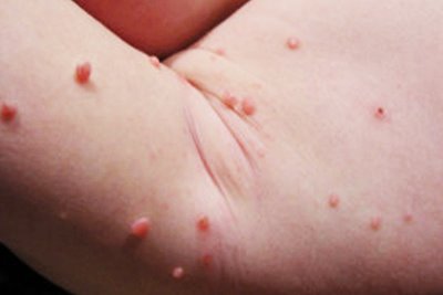 Molluscum Contagiosum