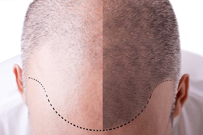 Hair Transplantation