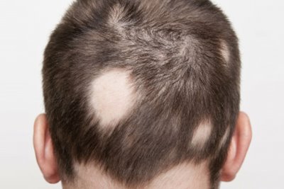 Alopecia Areata