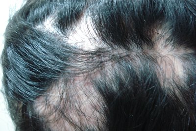 Alopecia