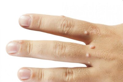 Warts And Their Treatments