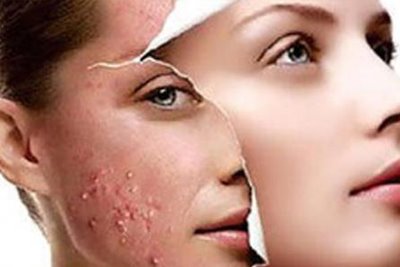 Acne Blemishes Treatment