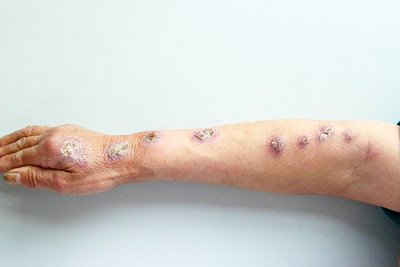 Sporotrichosis