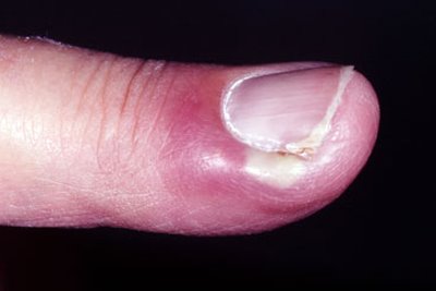 Ingrown Toenail - Dermatologic Disorders - Merck Manuals