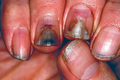 Nail Diseases